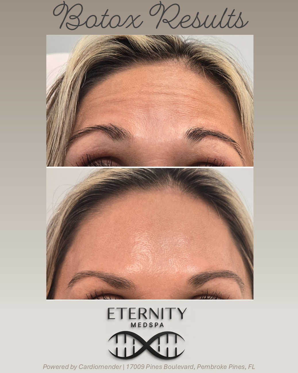 Botox wrinkle treatment at Eternity Medspa — Pembroke Pines, FL
