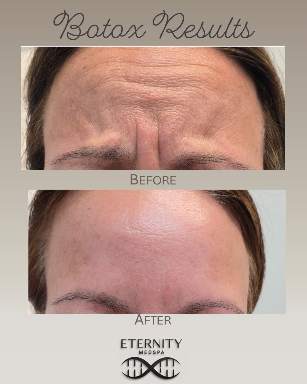 Botox forehead and brow treatment at Eternity Medspa