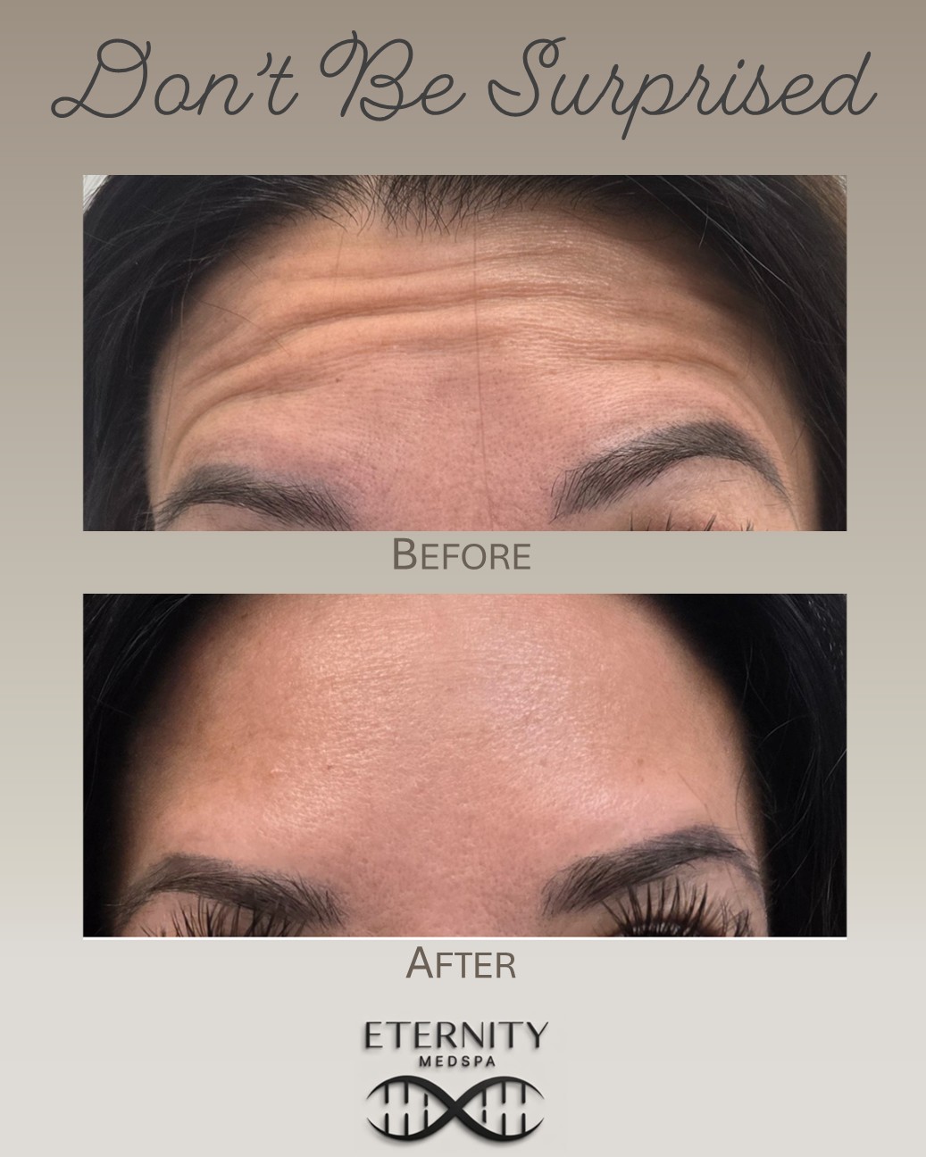 Botox results at Eternity Medspa — Pembroke Pines, FL