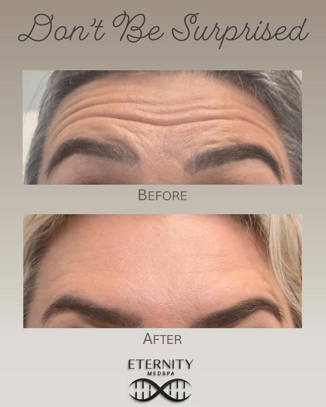 Botox treatment results at Eternity Medspa