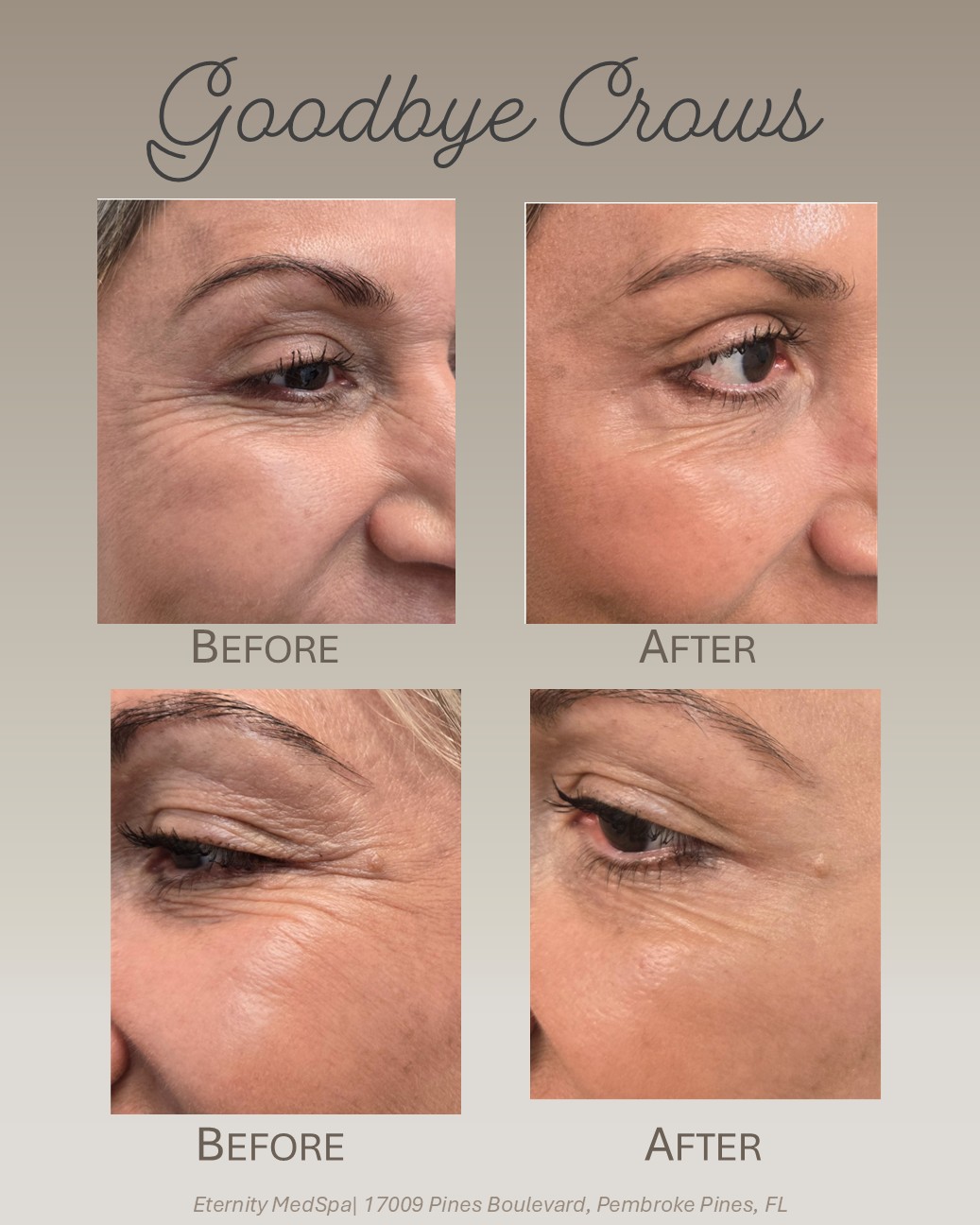 Preventative Botox for younger patients at Eternity Medspa