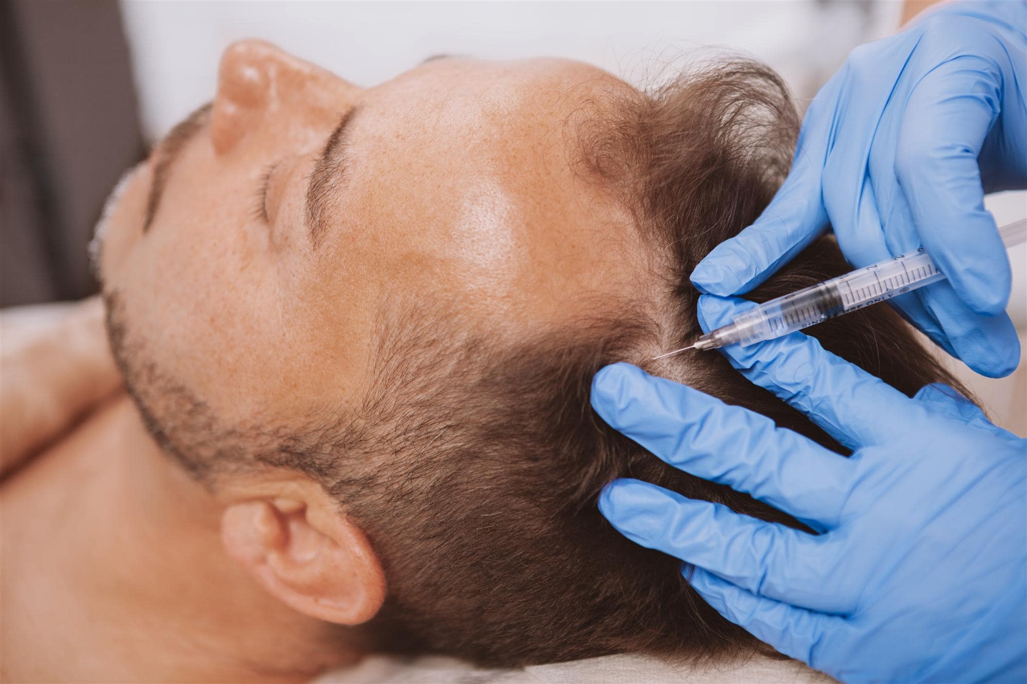 PRP Hair Restoration injection