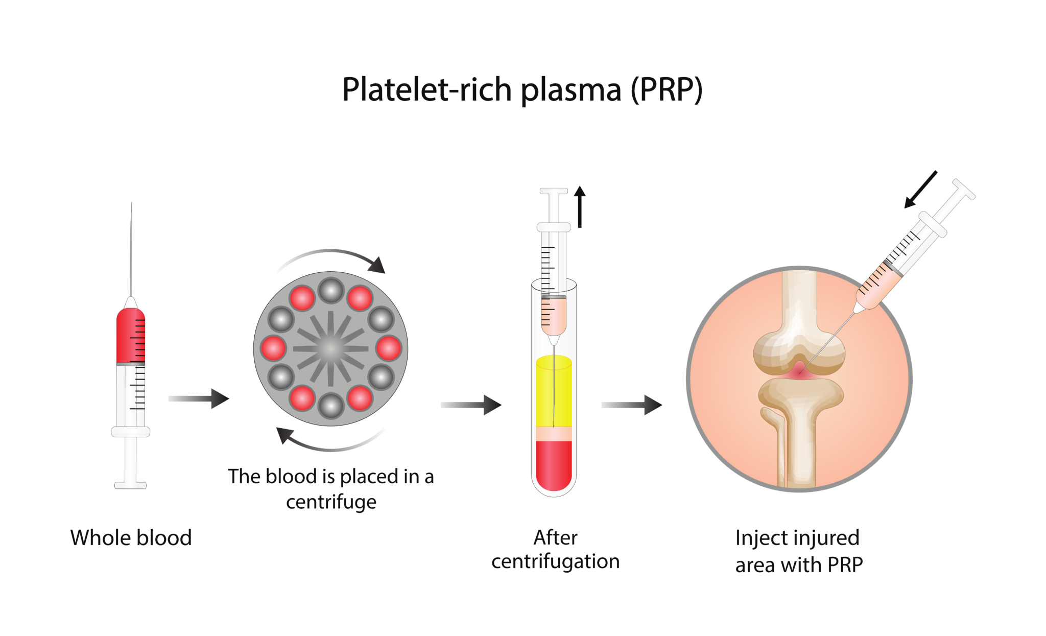 How PRP Therapy Works — Explainer