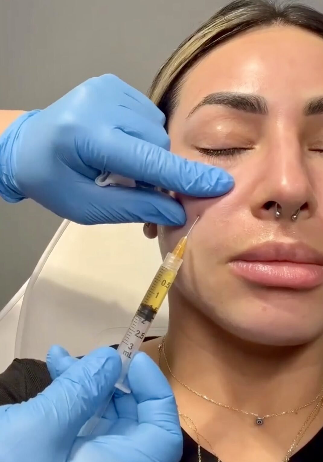 PRP facial injection for aesthetics