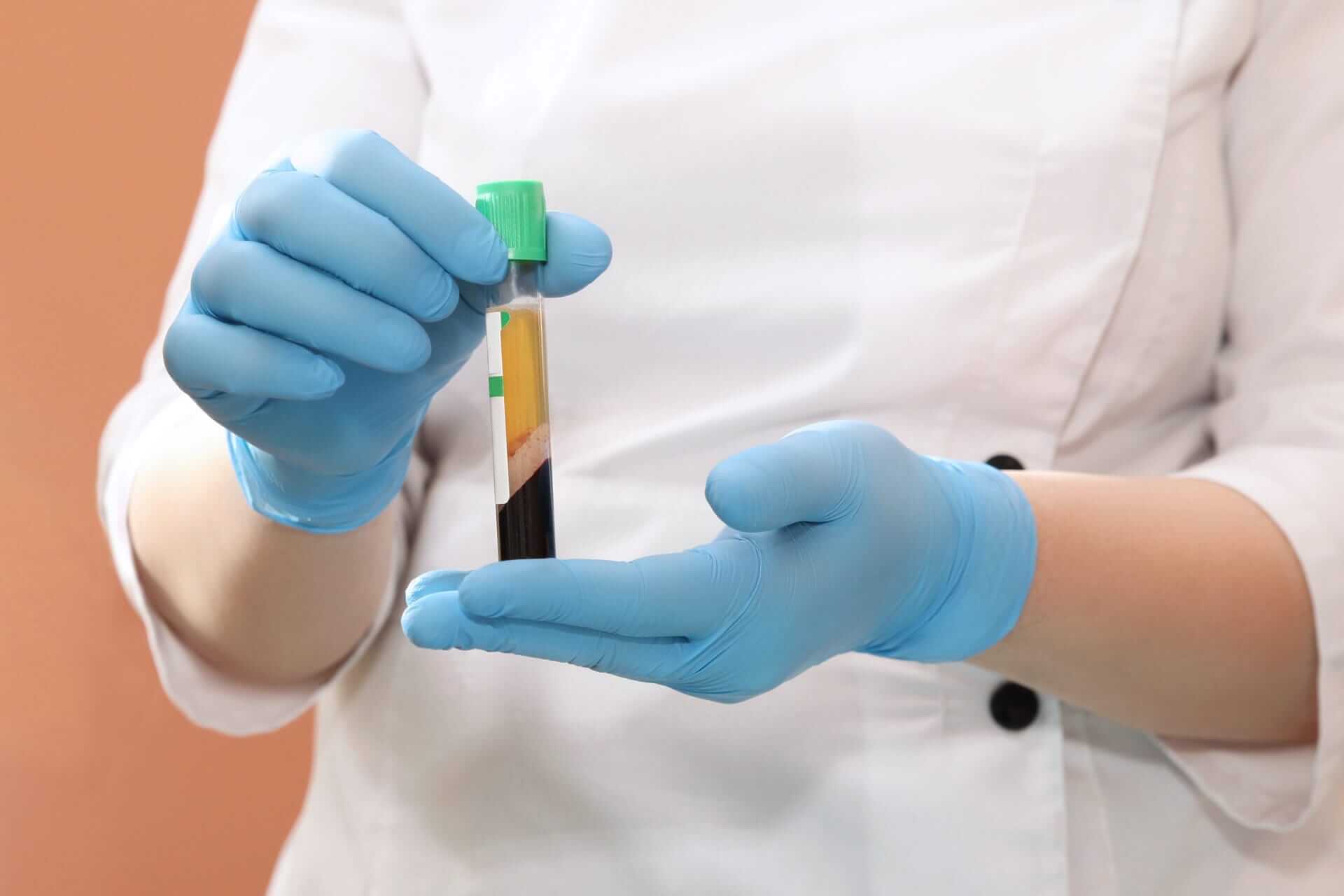 Platelet-rich plasma tube prepared for treatment